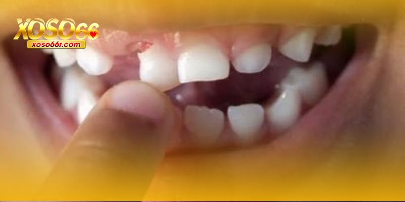 Mơ Thấy Rụng Răng XOSO66 – Giải Mã Giấc Mơ Và Con Số May Mắn 6 Con số may mắn tham khảo dự đoán lô.